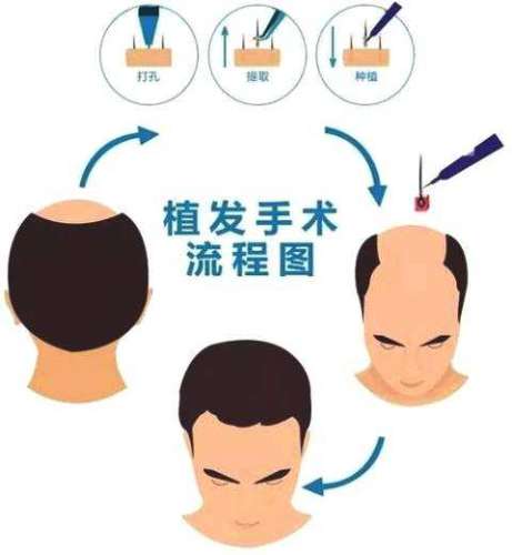 傅敏刚医生植发怎么样？上海仁济医院植发专家技术、价格与口碑预览