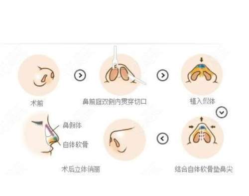 车金昊隆鼻怎么样？辽宁曙光技术派-美鼻无数\鼻型好看-2w元起