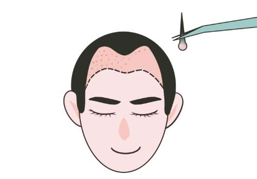 北大人民医院植发李翰林怎么样？副主任主刀，口碑不错，深度解析来了
