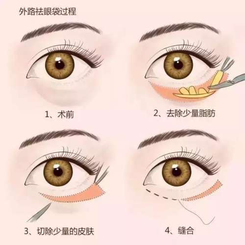 山东省立医院张健去眼袋怎么样？脂肪型\松弛型等都能做，价格5千元起