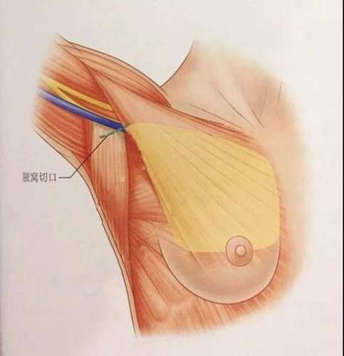 李如杰医生在国内隆胸的排名_台州维多利亚实力派专家技术\价格解析