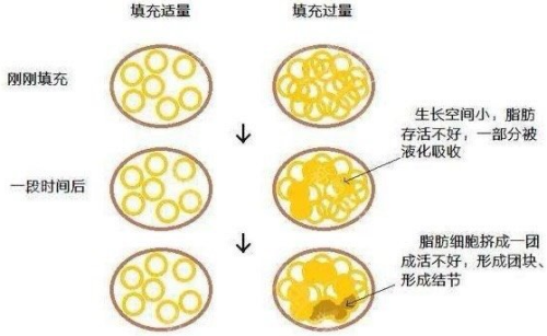 天津面部脂肪填充哪个医生好？2025年真人案例+数据报告，避坑指南看这篇就够了