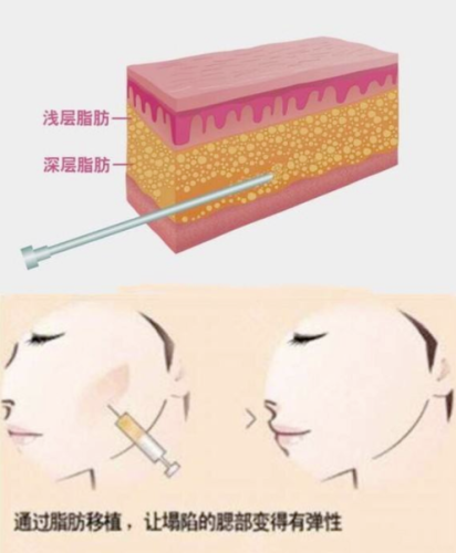 济南填充玻尿酸好医生怎么选？公立名医推荐+避坑指南