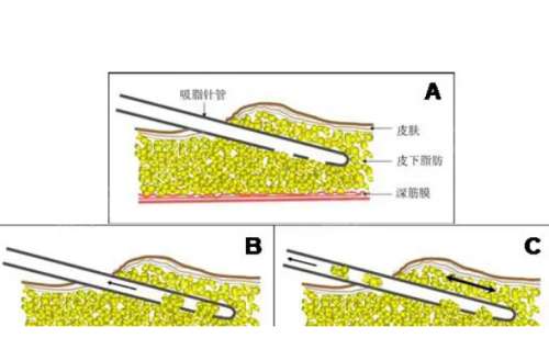 南方医科大学皮肤病医院鲜华吸脂一般多少钱?技术优点+术后6个月案例分析