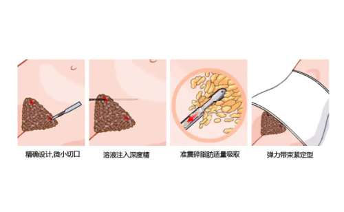 中日友好医院胡晓根腰腹吸脂技术评价怎么样?案例分析