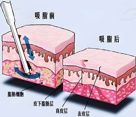 重庆吸脂做得好的医生：公立私立实力派PK