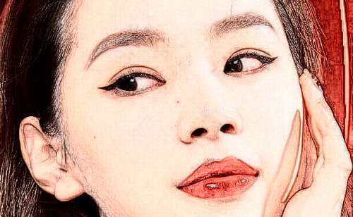 滕州市中心人民医院玻尿酸填充泪沟术后6个月案例分析