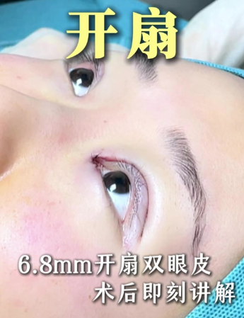 郑州第一人民医院赵丽双眼皮实测：20年功底造 “妈生眼”，闭眼无痕才是真自然