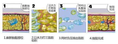 大连做吸脂比较好的医生推荐费用预估，吴紫权等入围前五~