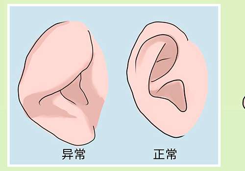河北工程大学附属医院谢玉娥杯状耳矫正术后三个月案例分析