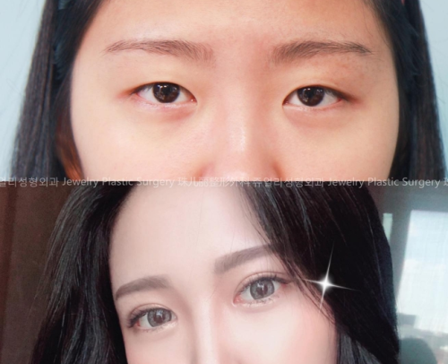 北京301医院割双眼皮谁比较好？从主任到教授，每一位都能让人放心