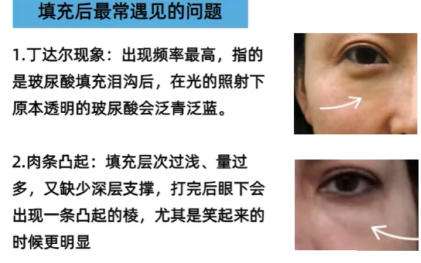 北京填充泪沟多少钱？全新价格表更新！