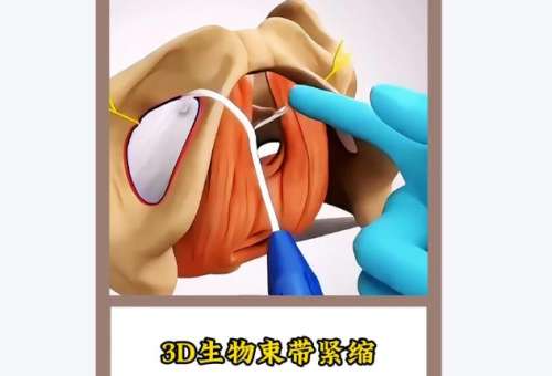 成都做3d生物束带紧缩术价格1.2w-3.2w元不等，棕南、恒博等技术全解析！