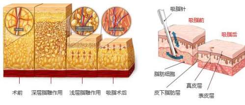 西安王仁根医生吸脂怎么样？画美脂肪精雕技术院长，价格2-3万元起