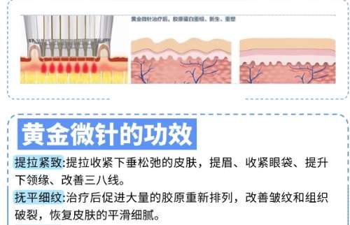 南方医院黄金微针价格表单新鲜出炉！效果如何？戳进来看！