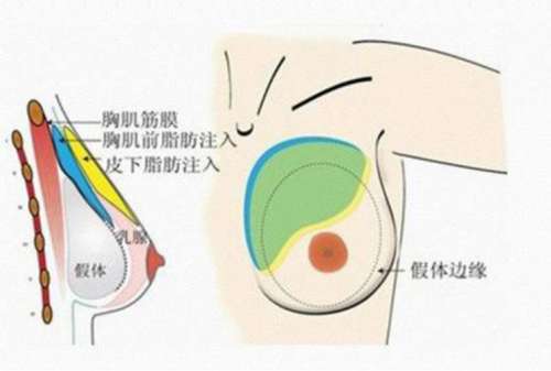深圳隆胸修复多少钱？当地做胸部整形性价比机构推荐！