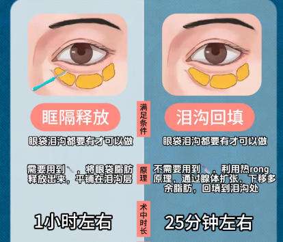 南方医院填充泪沟价格贵不贵？项目收费细节公布！