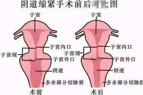 郑州三甲医院做松弛手术女性多少钱？阴道紧缩5千元-1.8万元起，必看攻略！