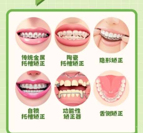 昆明地包天手术收费标准更新！推荐几家口碑又实惠的机构！