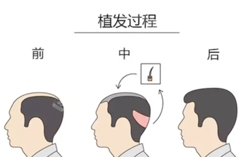 北京大学第一医院植发价格，单位毛囊价格、常见面积总价格区间大起底