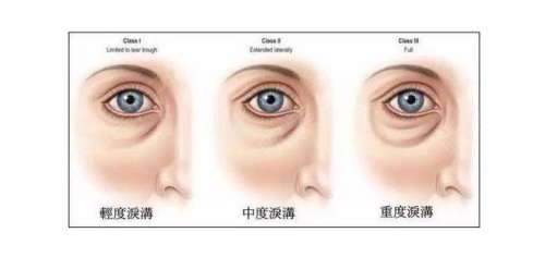 上海泪沟修复手术多少钱？最新价格_红榜医院排名速查！