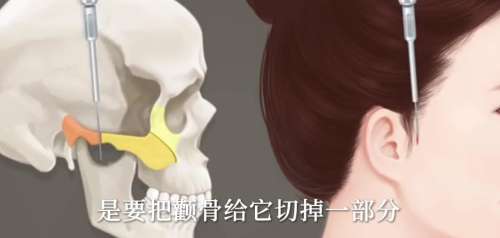 北京颧骨内推多少钱？医院项目费用参考！医院名单推荐