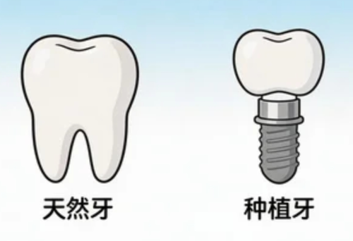 肇庆满口种植牙多少钱？全口真实价格出来了，普通人也能种得起