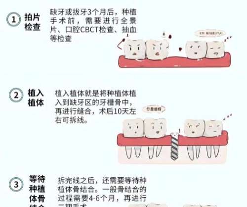 连云港全口种植牙多少钱？7-30万不等_价格表更新