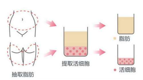 南方医院鲁峰自体脂肪填充多少钱？2万元起，带存活率案例分享！