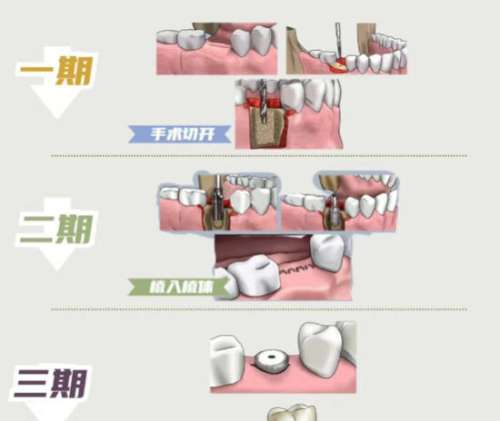 济南种植牙一颗多少钱？2026价格趋势全解析！含医院名单