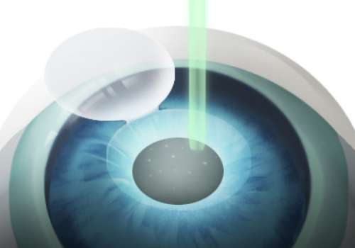 山东省眼科医院飞秒价格是多少？良心价1.2w起；