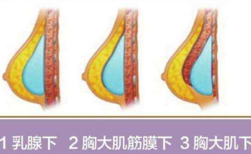 2026泉州海峡隆胸做的好吗?林婷婷，王振荣等实力较强