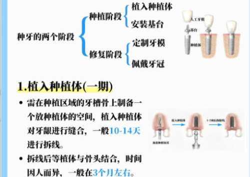 苏州种牙多少钱一颗啊？价格在3k至1w不等含人气医院推荐！