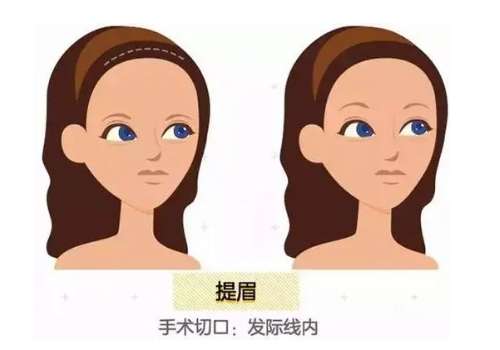 上海同济医院提眉手术费用多少？揭秘新费用，一般5000-15000元之间
