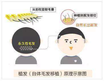 大连亲和植发价格多少？潘成城医生收费12000元起_含口碑评价分析