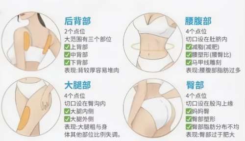 浙医二院抽脂多少钱？医院收费及避坑指南！