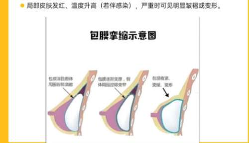 深圳隆胸修复多少钱？价格在3w左右含靠谱医院推荐
