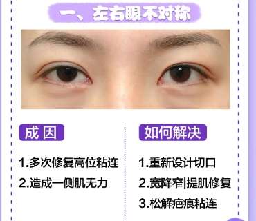 钟爱梅双眼皮价格贵不贵？费用一般在9k-3w元不等