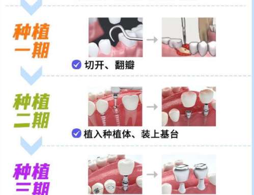 漳州种植牙多少钱一颗？半口种植6k起_前牙种植3k起