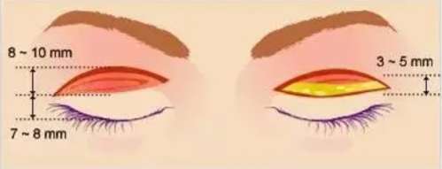 嘉兴华山医疗美容医院割双眼皮多少钱？眼部整形手术案例鉴赏