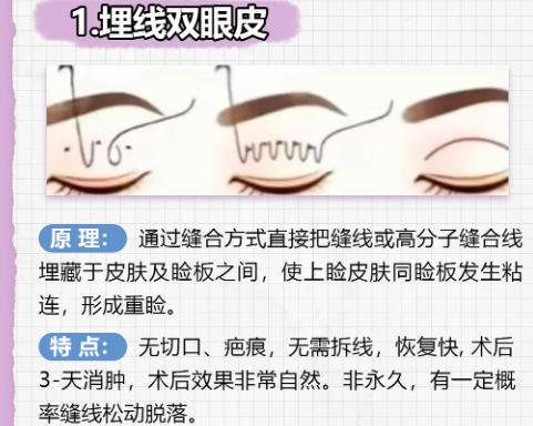 钟爱梅双眼皮案例详解来袭！附医生简介及真实案例效果分析