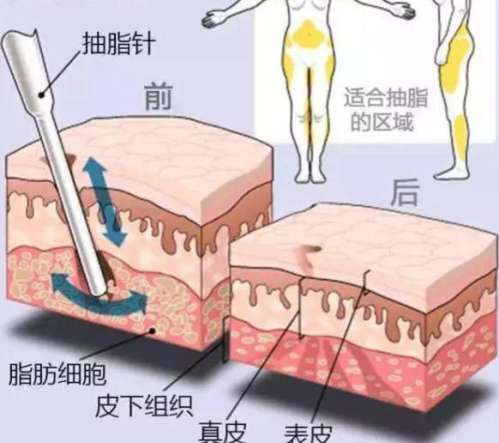 成都吸脂价格多少？各大医院价格表分析！