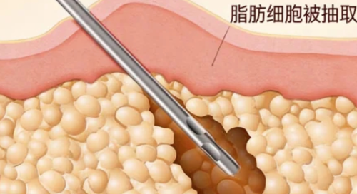 北京大学第三医院吸脂收费，腰腹、大腿、手臂等不同部位大概要多少钱？