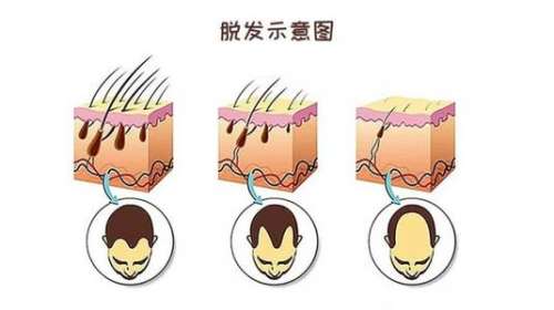 合肥曙光植发价格_医生全揭秘，谢宝山做不剃发植发经验多