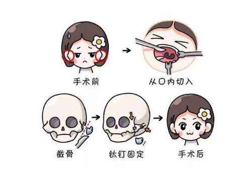 北京协和医院做下颌角多少钱？价格表新鲜出炉，医生与避坑指南
