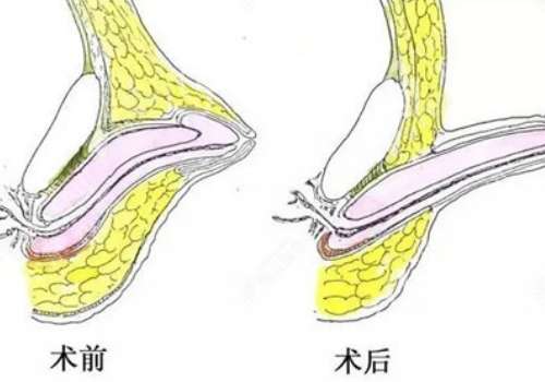 四川现代医院增粗手术费用多少？1万元起，医生、医院详情分享