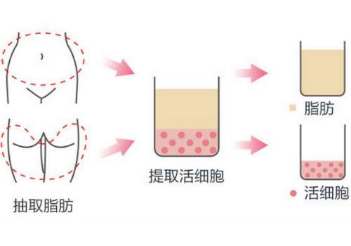 宁波第六医院脂肪填充价格！2026填充面部的价格1W+左右起