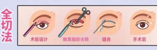 杭州整形医院双眼皮埋线多少价位？当地口碑医院及坐诊医生分享！