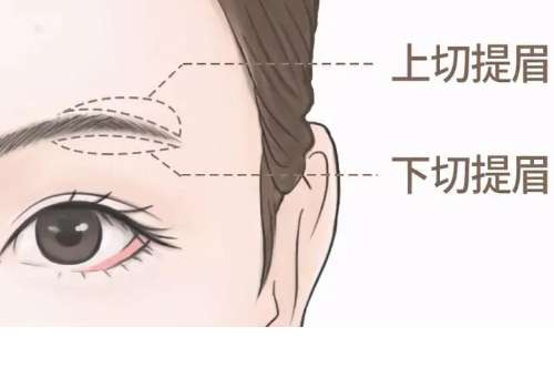 东莞提眉手术多少钱？5000元+起，靠谱医院基本信息分享，终于揭秘了