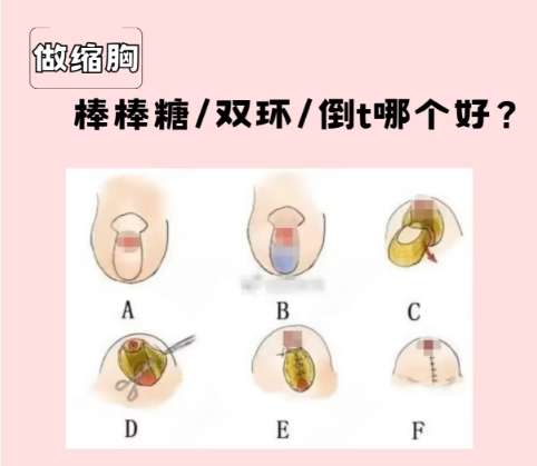 福州缩胸手术一般多少钱？2026价格表汇总！